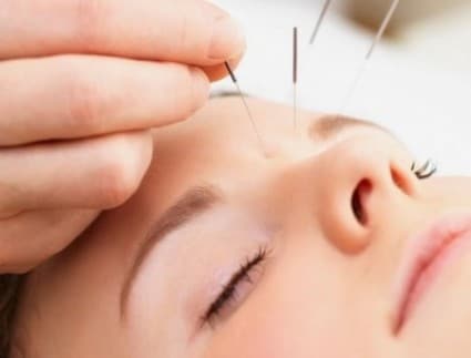 cosmetic acupuncture