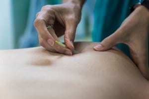 acupuncture treatment, doctor of chinese medicine, registered acupuncturist