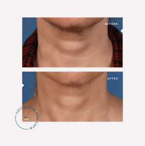 Image showing the benefits of microneedling for neck wrinkles.
