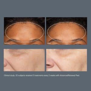 Chemical Peel Before and After photo