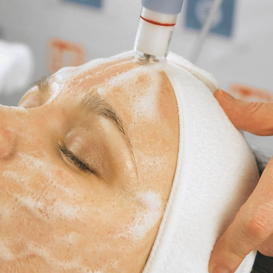 What Is Microdermabrasion and Do You Need It?