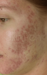 Example of post inflammatory pigmentation acne scars