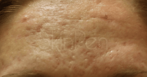 Example of rolling and boxcar acne scars