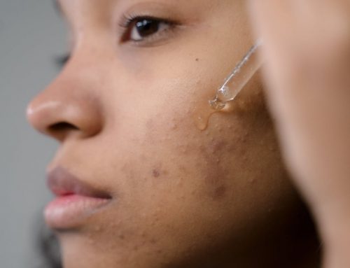 Acne scars: what you need to know and how to treat them